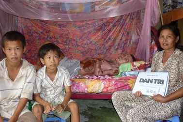 Hơn 30 triệu đồng đến với người đàn ông bị bỏng do điện giật