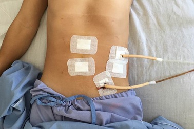 Cần Thơ: Giận vợ, tự đâm thủng dạ dày