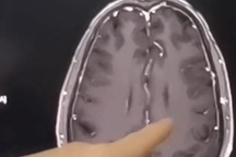 Người đàn ông não chi chít sán chỉ vì một món ăn