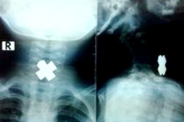 Dị vật hình chữ thập chắn ngang thực quản bé 3 tuổi