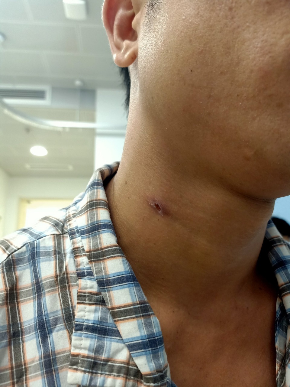 Thanh niên 29 tuổi bị súng bắn chim bắn xuyên từ cổ lên sau tai - 1 Thanh niên 29 tuổi bị súng bắn chim bắn xuyên từ cổ lên sau tai - 1