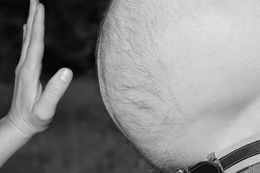 Cacbon dioxit làm giảm mỡ bụng