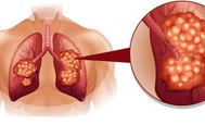 Dấu hiệu nhận biết sớm ung thư phổi