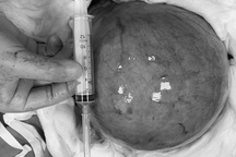 Cắt bỏ khối u xơ tử cung "khủng" nặng 2,5kg