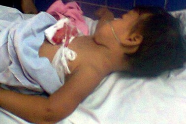 Cháu bé 2 tuổi nguy kịch vì lưỡi máy mài đâm vào ngực 