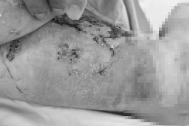 Bé trai 2 tuổi bỏng 60% cơ thể thương tâm, mẹ ruột hiến da cứu con