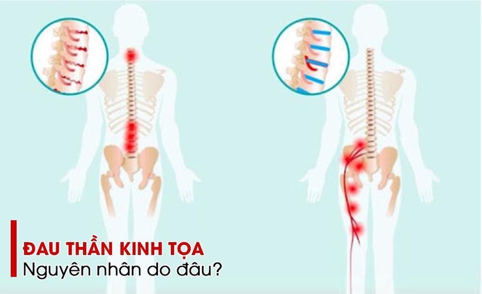 Cốt Thoái Vương - giải pháp giúp cải thiện đau thần kinh tọa - 1 Cốt Thoái Vương - giải pháp giúp cải thiện đau thần kinh tọa - 1