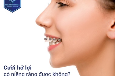 3 cách cười không hở lợi mới nhất bạn nên biết