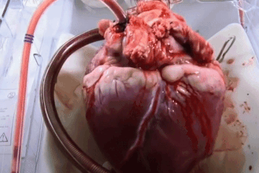 Các bác sĩ làm thế nào để giữ quả tim cấy ghép luôn đập trong ca phẫu thuật?