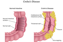 Bệnh Crohn có làm tăng nguy cơ ung thư không?