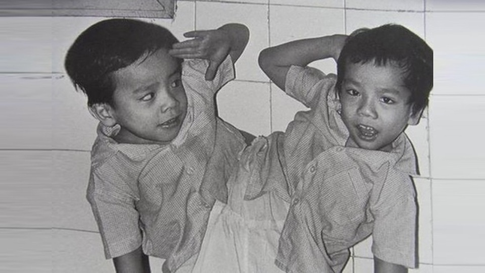 Cậu bé kiên cường sống sót sau ca mổ tách cặp song sinh 30 năm trước - 1 Cậu bé kiên cường sống sót sau ca mổ tách cặp song sinh 30 năm trước - 1