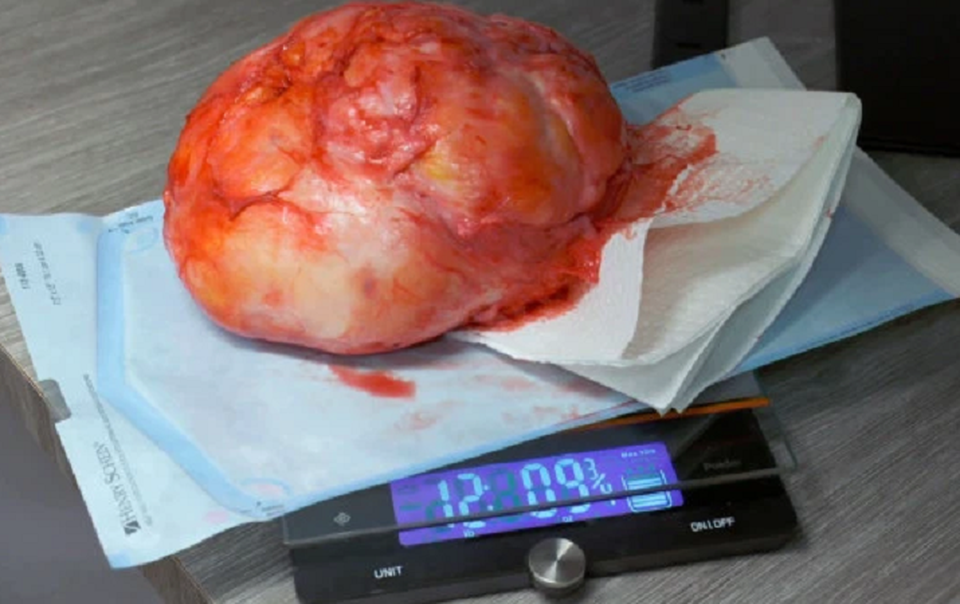 Người đàn ông được giải thoát khỏi khối bướu nặng 6kg mọc trên lưng - 3 Người đàn ông được giải thoát khỏi khối bướu nặng 6kg mọc trên lưng - 3