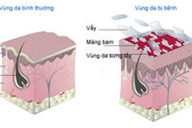 Nếu bị bệnh vẩy nến...