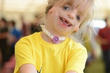 Gặp em bé "hạnh phúc nhất thế gian" dù khuôn mặt biến dạng sau 29 lần phẫu thuật