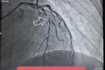 Tự dừng thuốc vì sợ khám "dính" Covid-19, bệnh nhân suýt chết vì đau ngực