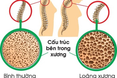 Dự phòng loãng xương ở bệnh nhân ung thư vú giai đoạn sớm