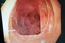 Hàng trăm giun móc ký sinh trong đại tràng thiếu nữ 14 tuổi