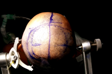 Phát hiện nứt sọ sau 2 ngày cụng đầu vào xà nhà