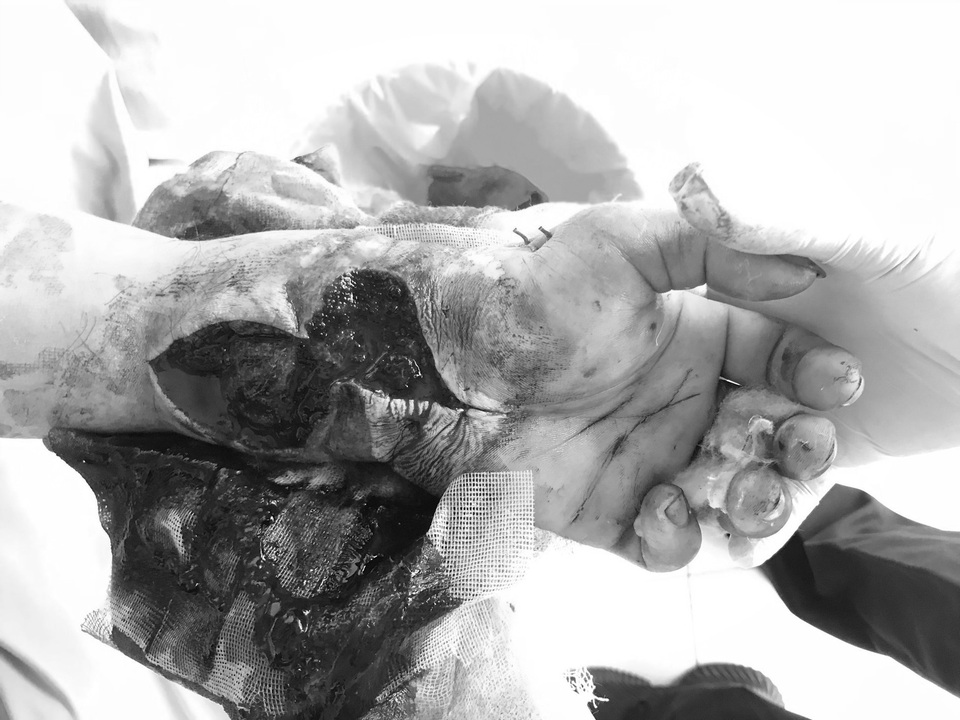 Nam công nhân bị dây kẽm siết suýt đứt cổ tay - 3