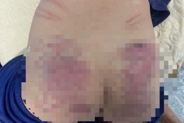 Xác minh vụ cháu bé 9 tuổi chậm phát triển nghi bị cô giáo bạo hành