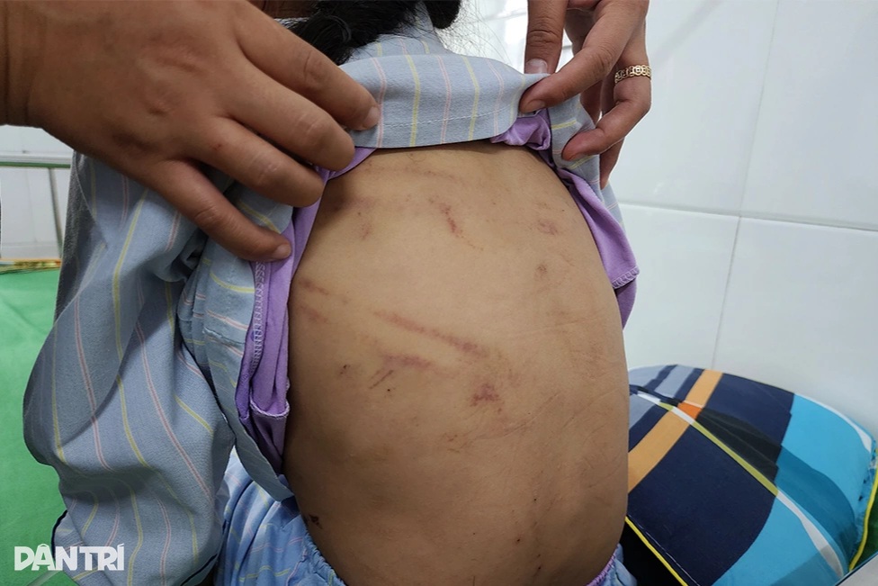 Sức khỏe của bé bị cha dượng dùng búa đánh vào đầu hiện ra sao? - 2