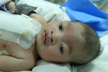 Thực hiện 2 ca mổ cùng lúc cứu bé trai bị suy tim, khe hở môi rộng