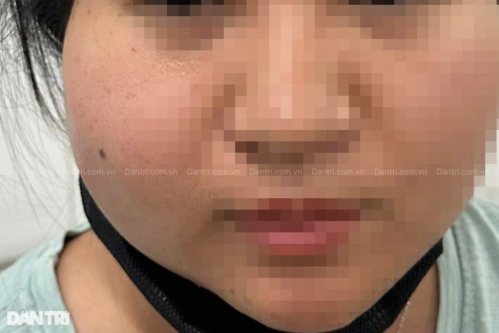 TPHCM: Cấp cứu 6 phụ nữ bị tai biến nặng nề vì tiêm filler - 1 TPHCM: Cấp cứu 6 phụ nữ bị tai biến nặng nề vì tiêm filler - 1