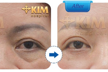 Lấy bọng mỡ mắt: Bí quyết lấy lại tuổi thanh xuân của chị em U40