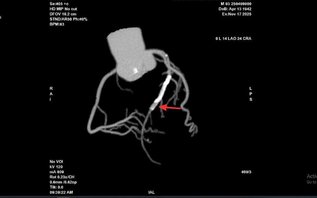 Tái hẹp 99% mạch vành sau đặt stent do ngưng uống thuốc điều trị - 1 Tái hẹp 99% mạch vành sau đặt stent do ngưng uống thuốc điều trị - 1