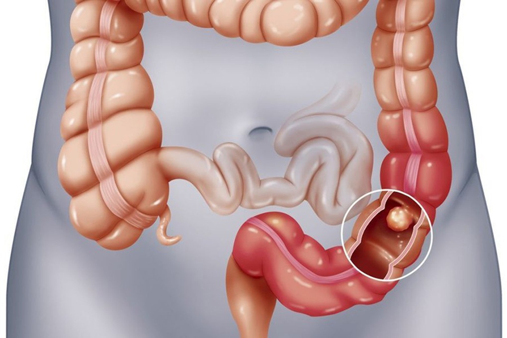 Ung thư và polyp khác nhau như thế nào? - 1 Ung thư và polyp khác nhau như thế nào? - 1