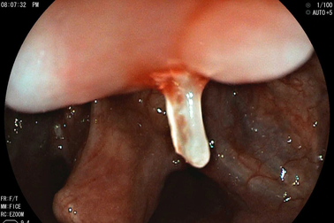 Thứ trong món cá khiến người đàn ông phải cấp cứu