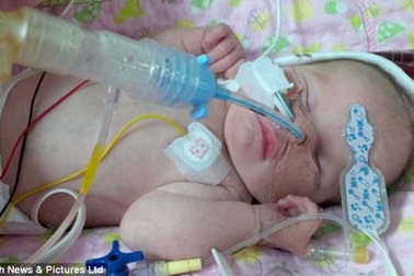 Lắp tim nhân tạo cho bé 13 ngày tuổi