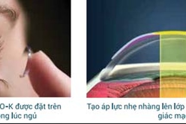 Có thể điều trị cận thị bằng Ortho- K không?