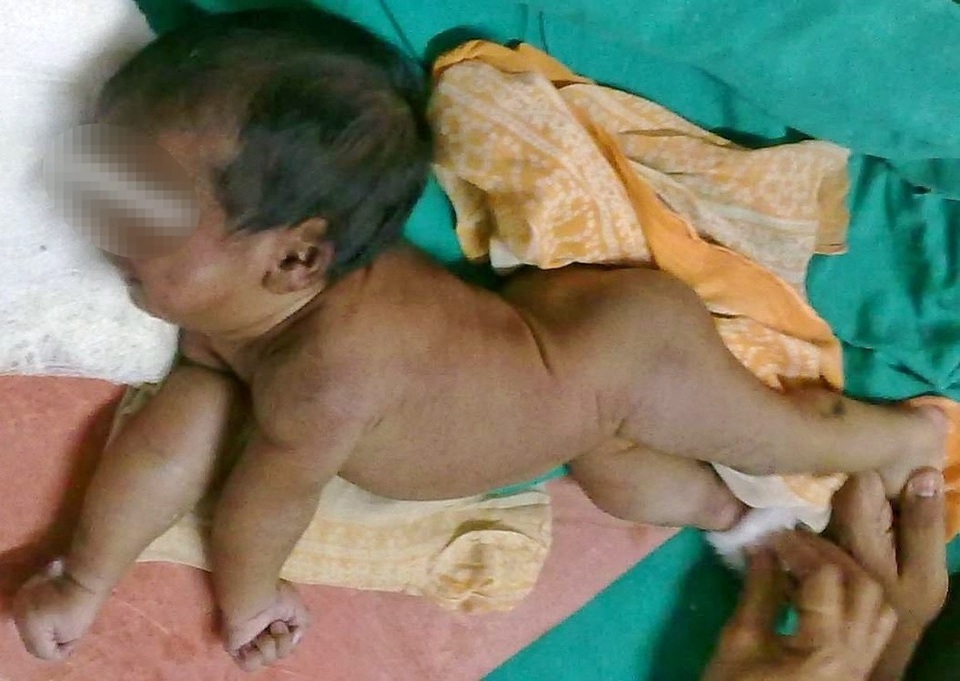 Không được chích ngừa, bé 18 tháng tuổi nguy kịch vì uốn ván - 1 Không được chích ngừa, bé 18 tháng tuổi nguy kịch vì uốn ván - 1