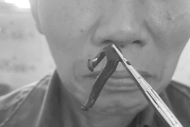 Ngạt mũi, chảy máu mũi suốt 2 tuần vì dị vật sống làm tổ trong mũi