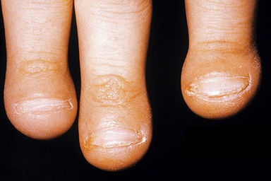 Các triệu chứng gây bất ngờ của ung thư phổi