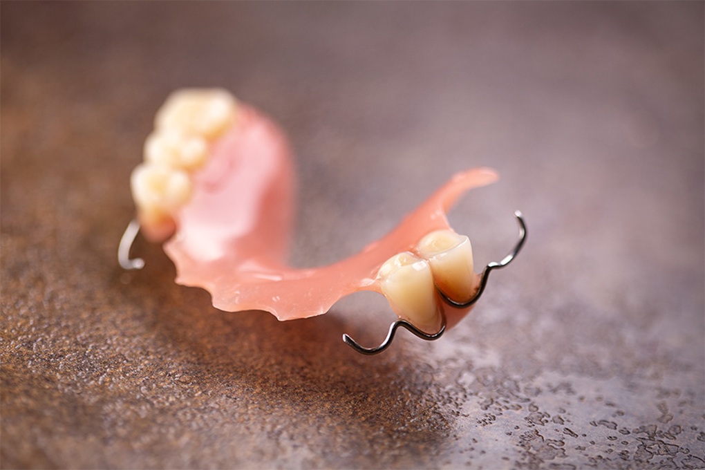 Rụng răng: Dấu hiệu của bệnh lý cần lưu ý và cách khắc phục - 4 Rụng răng: Dấu hiệu của bệnh lý cần lưu ý và cách khắc phục - 4