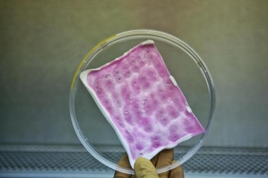 Băng tự tiêu ngăn ngừa nhiễm trùng ở bệnh nhân bỏng