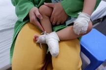 Mẹ dùng kem đánh răng chữa bỏng, bé trai phải nằm viện 4 tuần