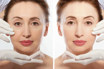 63 tuổi bị tiểu đường có đi căng da mặt được không?