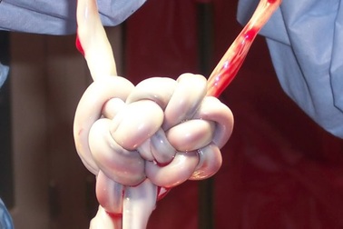 Cần đặc biệt lưu ý với trường hợp thai nhi bị dây rốn thắt nút