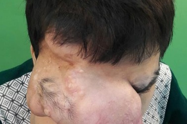 16 tiếng bóc khối u ‘khủng’ trên gương mặt