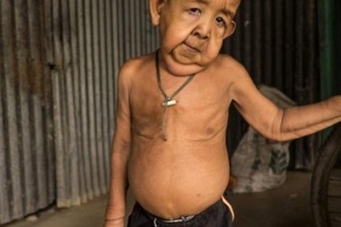 Cậu bé 4 tuổi trong hình hài ông lão 80