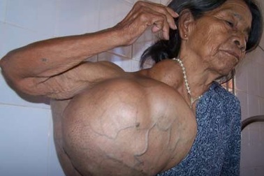 Phẫu thuật thành công khối u nặng 20kg ở vai