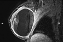 Nhiều phụ nữ gặp biến chứng nguy hiểm sau thời gian dài nâng ngực