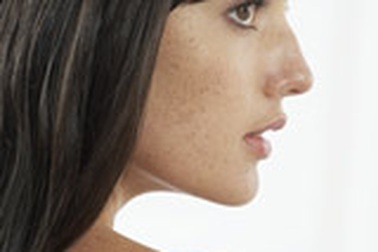 Loại trừ tàn nhang 