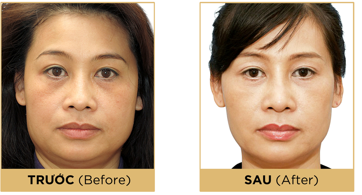 Tiến sĩ, Bác sĩ thẩm mỹ nâng cơ bằng chỉ nổi tiếng Hàn Quốc trở lại Việt Nam - 2 Tiến sĩ, Bác sĩ thẩm mỹ nâng cơ bằng chỉ nổi tiếng Hàn Quốc trở lại Việt Nam - 2