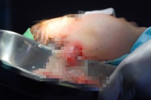 Tiêm tạo "má baby", trẻ hóa tái sinh, hot girl An Giang bị tai biến nặng nề