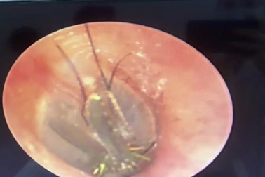 Muỗi hoa chui vào tai người phụ nữ 30 tuổi