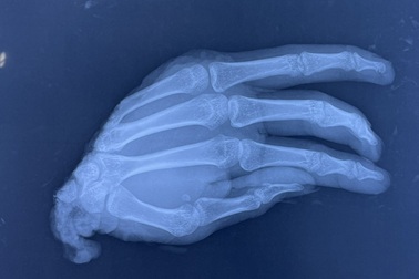 TPHCM: Chàng trai nhập viện lúc 0h với bàn tay đứt lìa bỏ vào thùng nước đá